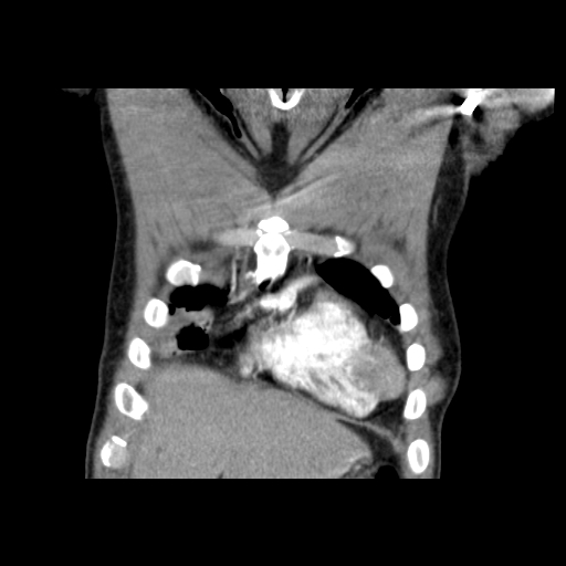 Acute segmental pulmonary emboli and pulmonary infarction (Radiopaedia 62264-70444 Coronal C+ CTPA 3).jpg