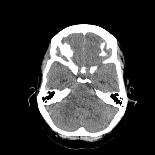 File:Acute subarachnoid hemorrhage and accessory anterior cerebral artery (Radiopaedia 69231-79008 Axial non-contrast 15).jpg