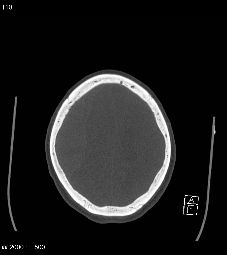 Acute subdural hematoma with myelofibrosis (Radiopaedia 52582-58494 Axial bone window 55).jpg