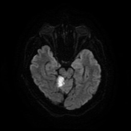Acute superior cerebellar artery territory infarct (Radiopaedia 84104-99358 Axial DWI 54).jpg