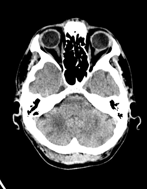 Acute superior cerebellar artery territory infarct (Radiopaedia 84104-99359 Axial non-contrast 51).jpg