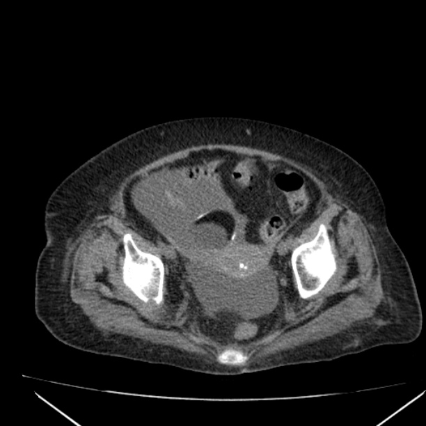 Acute tubular necrosis (Radiopaedia 28077-28334 Axial non-contrast 60).jpg