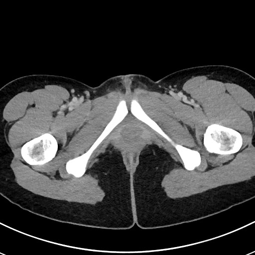 File:Acute uncomplicated appendicitis (Radiopaedia 61374-69304 Axial C+ portal venous phase 140).jpg