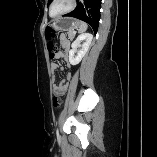 Acute uncomplicated appendicitis (Radiopaedia 73704-84499 Sagittal C+ portal venous phase 141).jpg