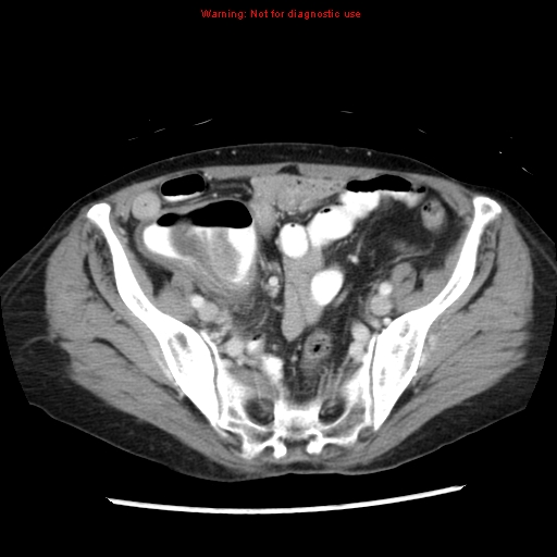 Adenocarcinoma of the colon (Radiopaedia 8191-9039 Axial liver window 59).jpg