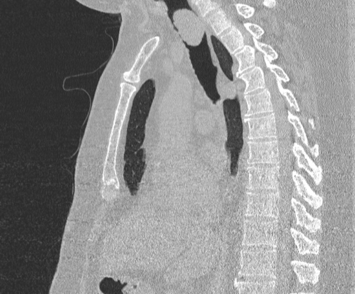 Adenoid cystic carcinoma of the trachea (Radiopaedia 49042-54137 Sagittal lung window 230).jpg