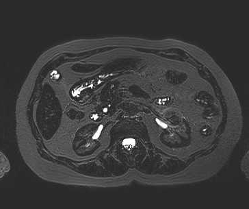File:Adenomyomatosis of the gallbladder (Radiopaedia 50246-55587 Axial 29).png
