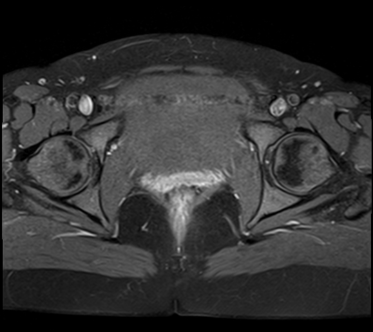 File:Adenomyosis - ovarian endometriomas (Radiopaedia 67031-76350 Axial T1 C+ fat sat 22).jpg