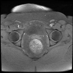 File:Adenomyosis within a didelphys uterus (Radiopaedia 70175-80215 Axial T1 fat sat 32).jpg