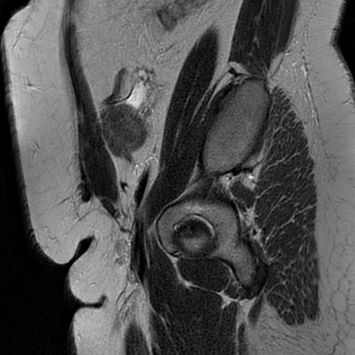File:Adenomyosis within a didelphys uterus (Radiopaedia 70175-80215 Sagittal T2 34).jpg