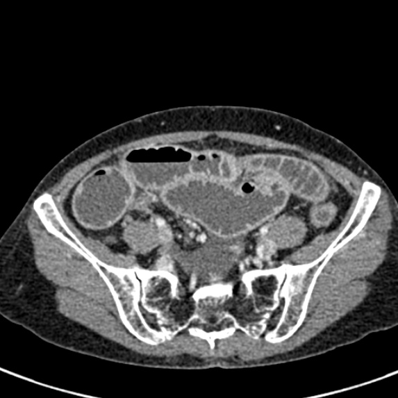 Adhesional small bowel obstruction (Radiopaedia 48397-53305 Axial C+ portal venous phase 68).jpg