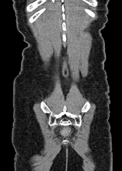 Adhesional small bowel obstruction (Radiopaedia 48397-53305 Coronal C+ portal venous phase 323).jpg