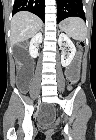 File:Adhesional small bowel obstruction (Radiopaedia 52107-57980 Coronal C+ portal venous phase 54).jpg
