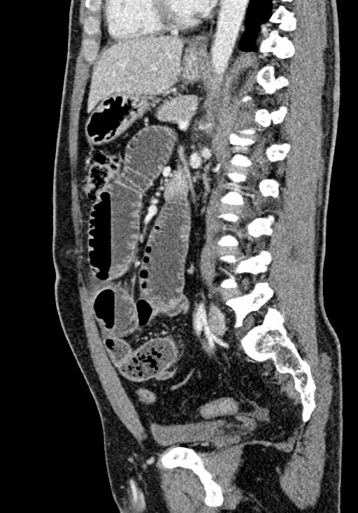 Adhesional small bowel obstruction (Radiopaedia 58900-66131 Sagittal C+ portal venous phase 145).jpg