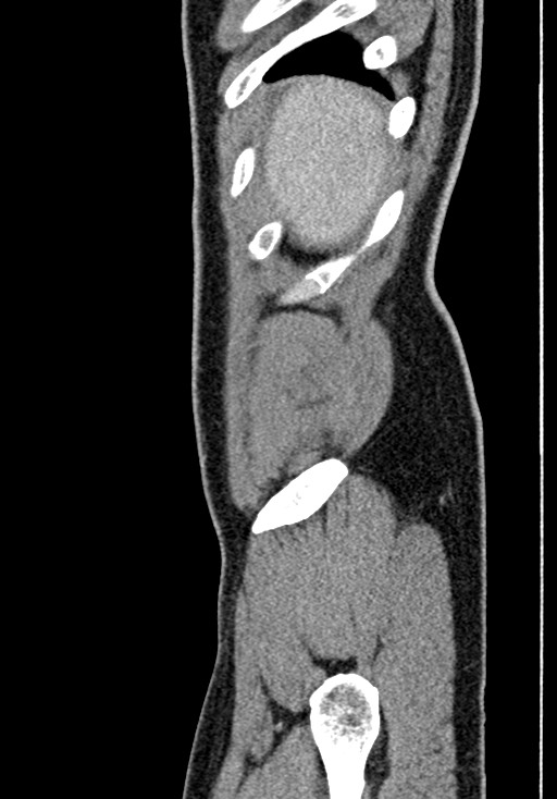 Adhesional small bowel obstruction (Radiopaedia 58900-66131 Sagittal C+ portal venous phase 21).jpg