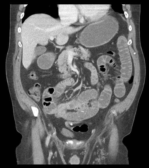 File:Adhesions within abdominal wall hernia (Radiopaedia 58283-65394 Coronal C+ portal venous phase 32).png