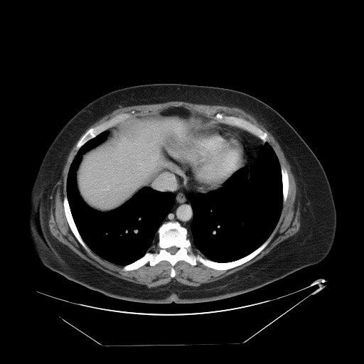 File:Adrenal angiosarcoma (Radiopaedia 81081-94671 Axial C+ portal venous phase 6).jpg