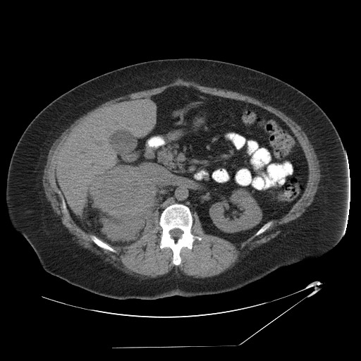 Adrenal angiosarcoma (Radiopaedia 81081-94671 Axial non-contrast 31).jpg