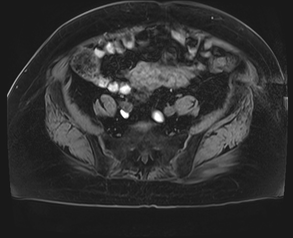 Adrenal cortical carcinoma (Radiopaedia 64017-72770 Axial T1 C+ fat sat 71).jpg