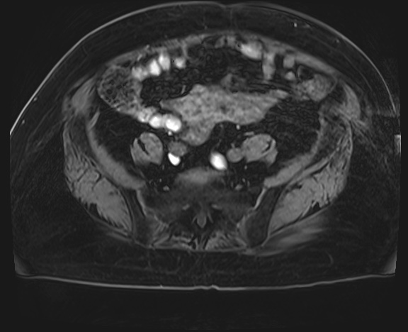 Adrenal cortical carcinoma (Radiopaedia 64017-72770 H 70).jpg