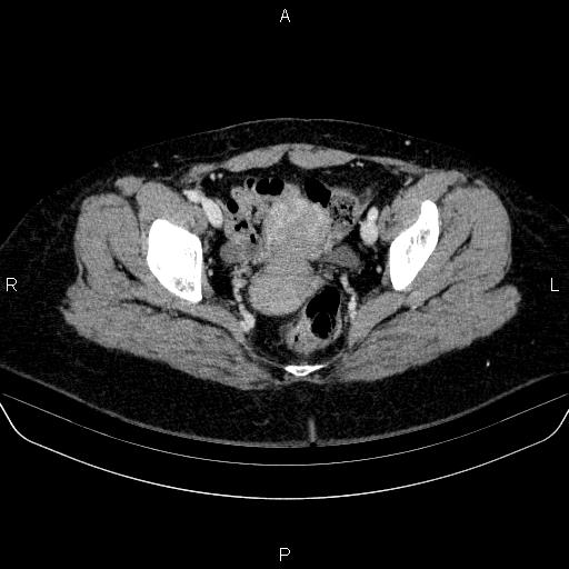File:Adrenal cortical carcinoma (Radiopaedia 84882-100379 Axial C+ portal venous phase 86).jpg