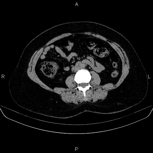 File:Adrenal cortical carcinoma (Radiopaedia 84882-100379 Axial non-contrast 48).jpg