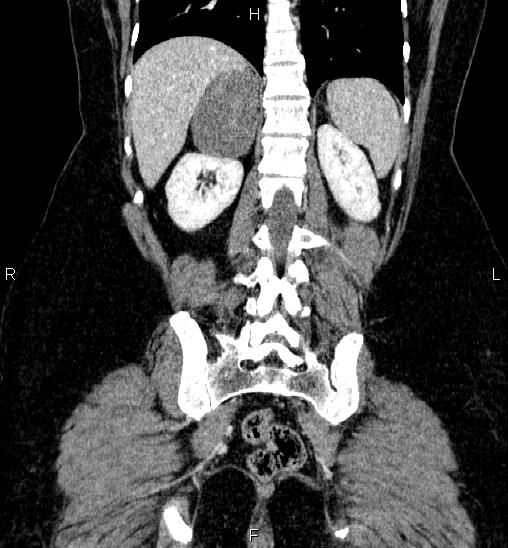 Adrenal cortical carcinoma (Radiopaedia 84882-100379 Coronal C+ portal venous phase 48).jpg