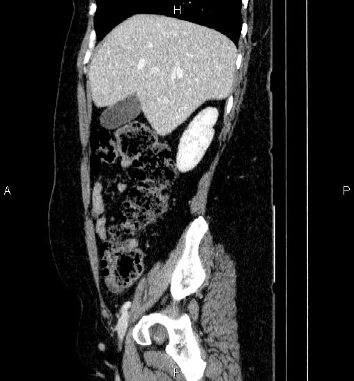 Adrenal cortical carcinoma (Radiopaedia 84882-100379 Sagittal C+ portal venous phase 23).jpg