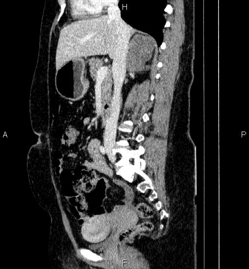Adrenal cortical carcinoma (Radiopaedia 84882-100379 Sagittal C+ portal venous phase 41).jpg