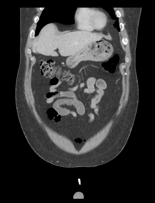 Adrenal cyst (Radiopaedia 45625-49777 Coronal C+ portal venous phase 18).png