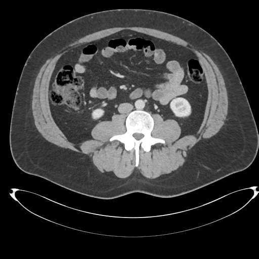 File:Adrenal cyst (Radiopaedia 45625-49778 AXIAL THICK 60 sec 59).png
