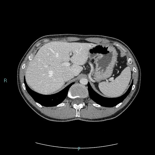 Adrenal cystic lymphangioma (Radiopaedia 83161-97534 Axial C+ portal venous phase 23).jpg