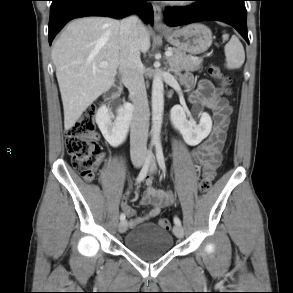 Adrenal cystic lymphangioma (Radiopaedia 83161-97534 Coronal C+ portal venous phase 36).jpg