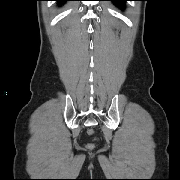 Adrenal cystic lymphangioma (Radiopaedia 83161-97534 Coronal C+ portal venous phase 67).jpg