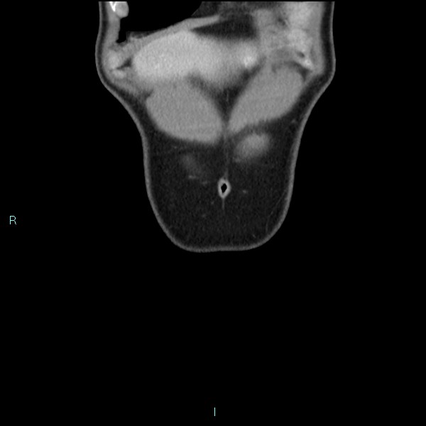 Adrenal cystic lymphangioma (Radiopaedia 83161-97534 Coronal C+ portal venous phase 9).jpg