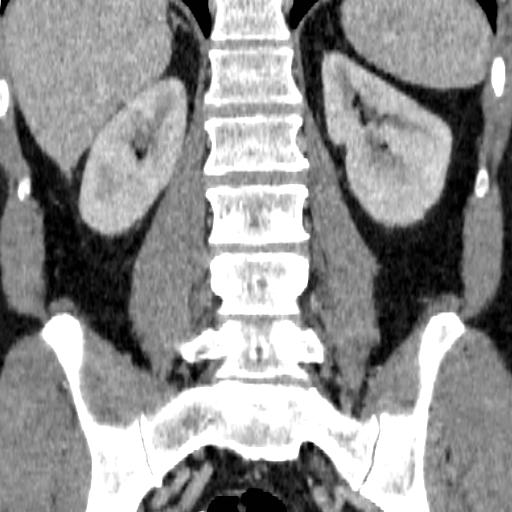 File:Adrenal glands (normal CT anatomy) (Radiopaedia 16570-105725 Coronal 18).jpg