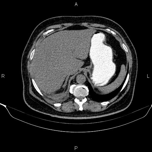 Adrenal hemorrhage (Radiopaedia 62622-70916 Axial non-contrast 31).jpg