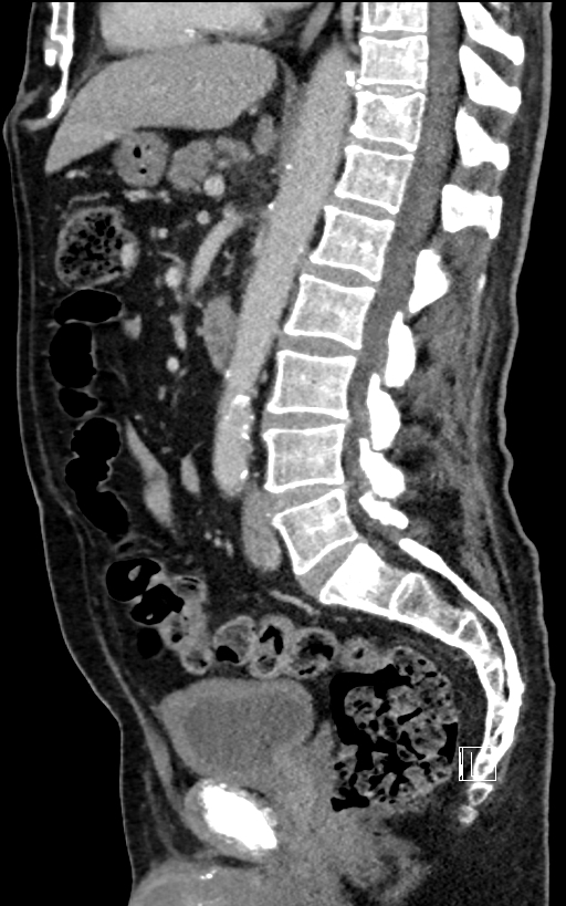 Adrenal lymphoma (Radiopaedia 73730-84529 Sagittal C+ portal venous phase 58).jpg