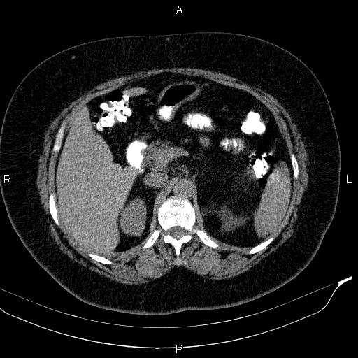 Adrenal myelolipoma (Radiopaedia 84319-99617 Axial With oral contrast 72).jpg