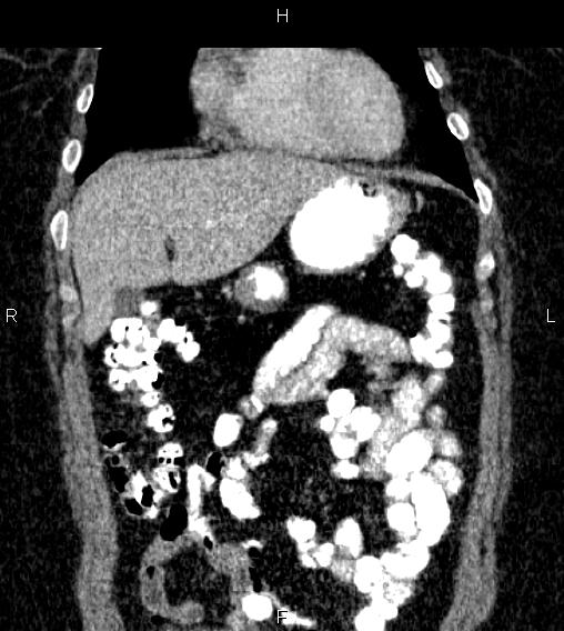 Adrenal myelolipoma (Radiopaedia 84319-99617 Coronal renal cortical phase 19).jpg