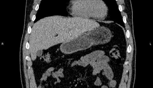 Adrenal myelolipoma (Radiopaedia 84321-99619 Coronal non-contrast 19).jpg