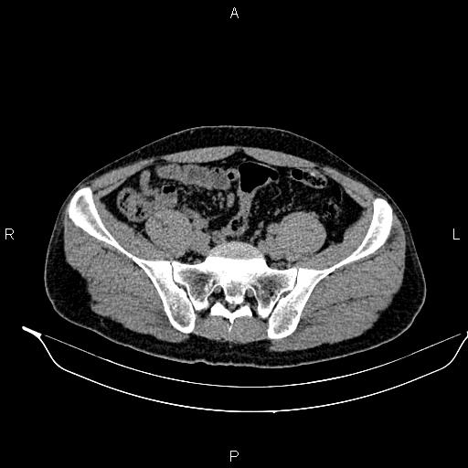 Adrenal myelolipoma (Radiopaedia 87794-104246 Axial non-contrast 80).jpg