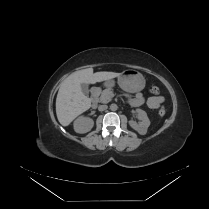Adrenal myelolipoma - MRI (Radiopaedia 83249-97647 Axial non-contrast 54).jpg