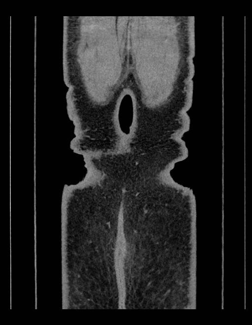 Adrenal myelolipoma - bilateral (Radiopaedia 74805-85810 Coronal C+ portal venous phase 36).jpg
