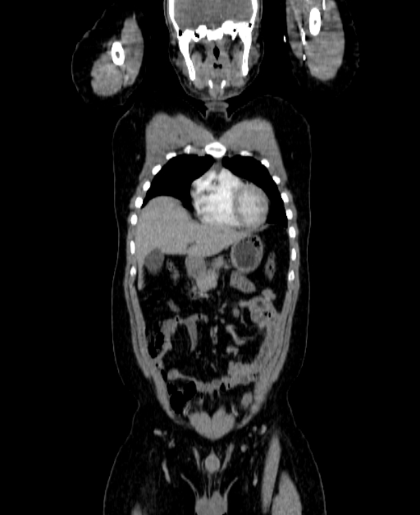 Adrenocortical carcinoma (Radiopaedia 80134-93438 Coronal C+ portal venous phase 48).jpg