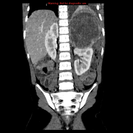File:Adrenocortical carcinoma (Radiopaedia 9449-10131 Coronal C+ portal venous phase 12).jpg