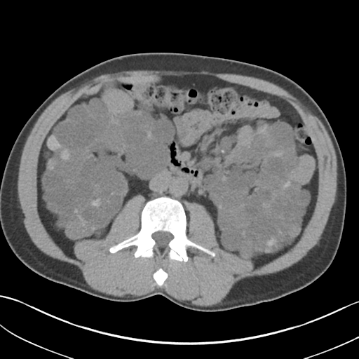 File:Adult polycystic kidney disease (Radiopaedia 47866-52626 Axial non-contrast 38).png