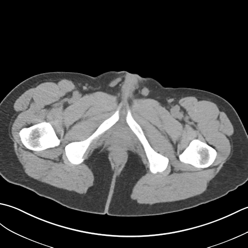 File:Adult polycystic kidney disease (Radiopaedia 47866-52626 Axial non-contrast 92).png