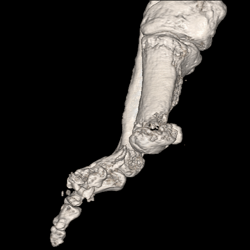 File:Advanced osteomyelitis due to open metatarsal fracture (Radiopaedia 83891-99095 VRT 6).jpg