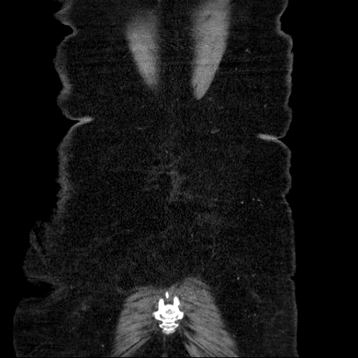 File:Afferent loop syndrome - secondary to incarcerated trocar site hernia (Radiopaedia 82959-97305 Coronal C+ portal venous phase 135).jpg